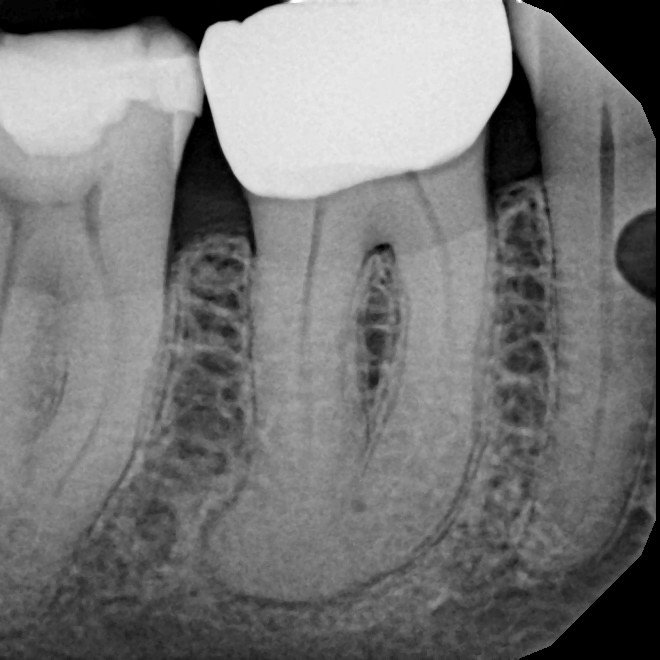 Before Endodontic Treatment Case 6 - Harp Endodontics Manhattan New York