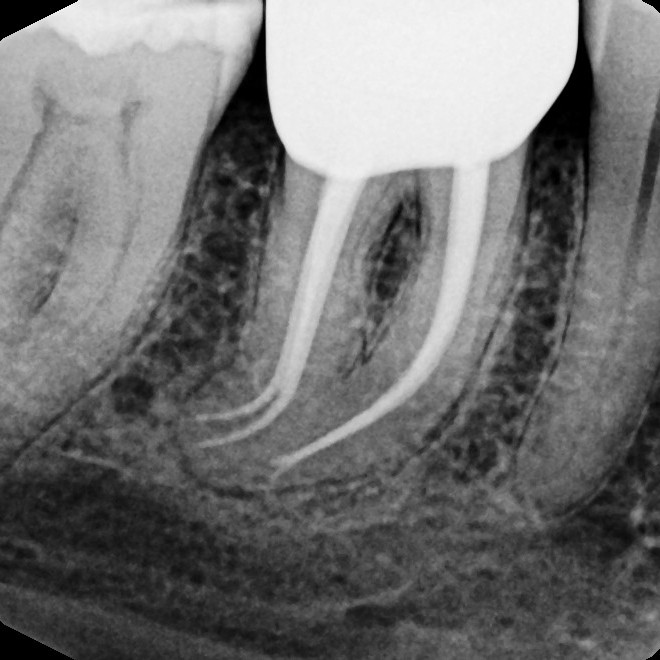 After Endodontic Treatment Case 6 - Harp Endodontics Manhattan New York