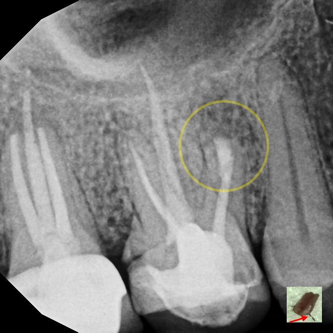 After Endodontic Treatment Case 7 - Harp Endodontics Manhattan New York