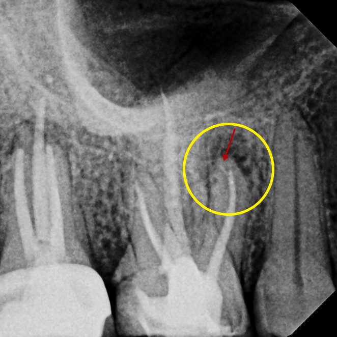 Before Endodontic Treatment Case 7 - Harp Endodontics Manhattan New York